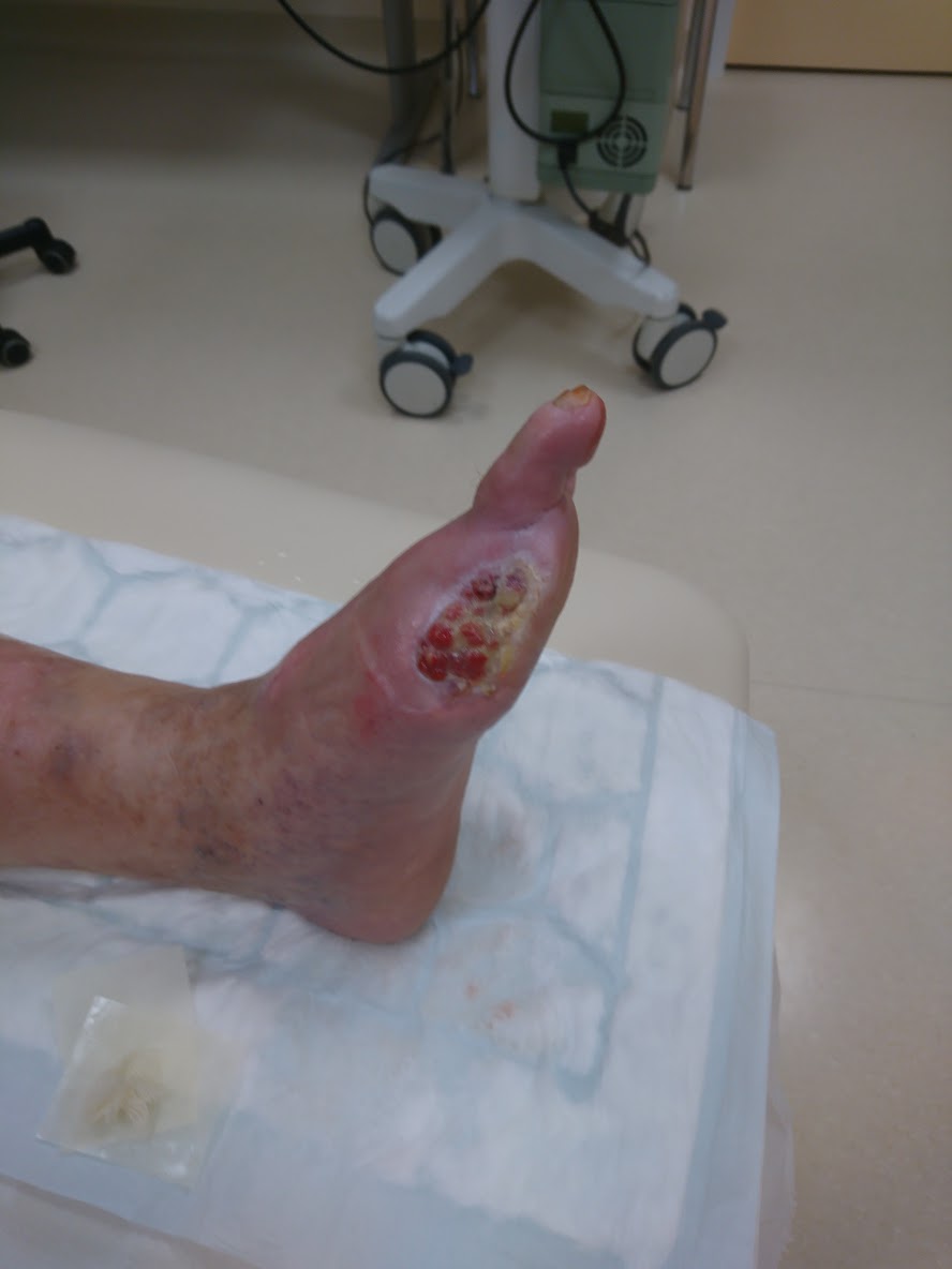 Notranja stran stopala ohranja bioarhitektoniko, kar omogoča bolniku dobro gibanje